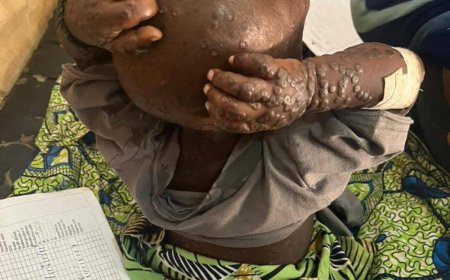 Kasaï -Oriental : six nouveaux cas suspects de Mpox identifiés à Kabeya Kamuanga