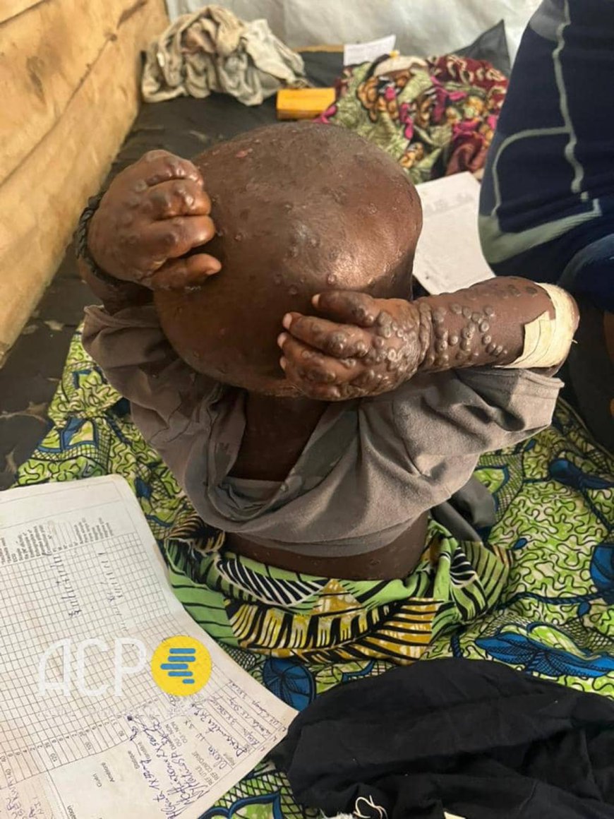 Kasaï -Oriental : six nouveaux cas suspects de Mpox identifiés à Kabeya Kamuanga